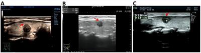 Single-center external validation and reconstruction of multiple predictive models for skip lateral lymph node metastasis in papillary thyroid carcinoma